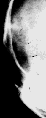 XRAY of skull damage
